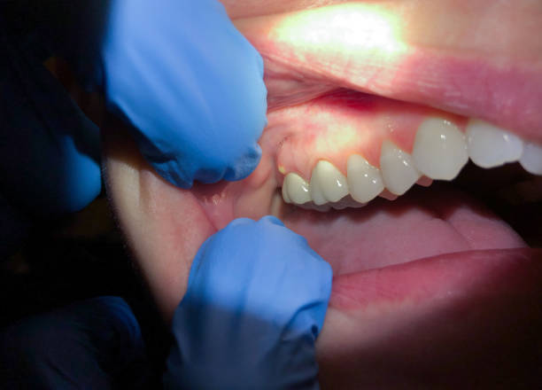 Best Knocked-Out Tooth Emergency  in Port Jefferson Station, NY